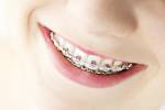 Closeup auf Hosenträger und weiße Zähne der lächelnden Mädchen Lizenzfreie Bilder - 13306524