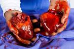 Herztransplantation, um das Leben eines Patienten zu retten Lizenzfreie Bilder - 16270083