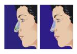 Schematische Darstellung der Rhinoplastik Lizenzfreie Bilder - 16304223