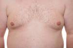 Männlich Thorax zeigt frühzeitig Gynäkomastie oder Mann boobs auch ein Synonym von Fettleibigkeit Lizenzfreie Bilder - 19352268