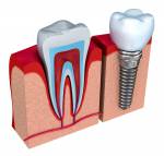 Anatomie des gesunden Zähnen und Zahnimplantat in Kieferknochen. Lizenzfreie Bilder - 32591656