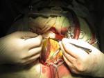 Koronaren Bypass-Operation mit Herz-Lungen-Maschine Lizenzfreie Bilder - 4465622
