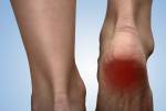 Schmerzhafte Ferse mit roten Fleck auf Frau Fuß. Arthritis. Sole Sporn Konzept. Fersenschmerzen bei Frauen. Schmerzen Konzept Lizenzfreie Bilder - 45715316