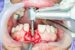Zahnimplantate Chirurgie in realen Patienten Lizenzfreie Bilder - 48212433