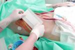 U-Nieren-Transplantation Chirurgie Konzept Lizenzfreie Bilder - 49131318