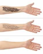 Tattoo auf männliche Hand. Laser-Tattoo-Entfernung Konzept Lizenzfreie Bilder - 55688024