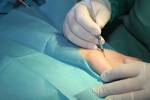 Ein Chirurg führt ein Karpaltunnelsyndrom Chirurgie durch Lizenzfreie Bilder - 61354004