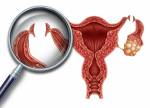Tubenligatur Reproduktion medizinische Verfahren für die Sterilisation der Frau als Uterus mit Einschnitten auf die Eileiter aus dem Ei zu blockieren mit 3D-Darstellung Elemente als Fruchtbarkeits und Gynäkologie Medizin Konzept befruchtet. Lizenzfre