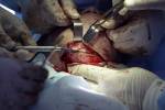 Chin Chirurgie close-up mit offener Wunde und ein Einschnitt an einem Knochen Lizenzfreie Bilder - 66952162