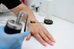 Die Entfernung von Warzen in der Dermatologie Klinik. Der Arzt entfernt Haut Formationen mit SpezialausrÃ¼stung - kriodestruktor. Papillome, Warzen, Onkologie Lizenzfreie Bilder - 66982602