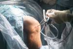 Knie-Schlüsselloch-Chirurgie Krankenhaus Arthroskopie Operation medizinische Verfahren in der Notaufnahme OP. Lizenzfreie Bilder - 70235053
