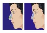 Schematische Darstellung der Rhinoplastik Lizenzfreie Bilder - 16304223