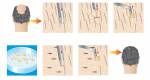 Haartransplantation follikuläre Einheit Extraktion Lizenzfreie Bilder - 19696741