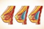Anatomie der Brust und Implantate Vector Lizenzfreie Bilder - 16139716