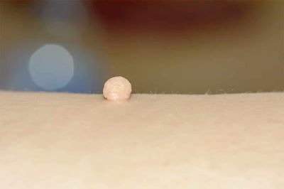 Fibrom