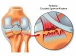 Posterior Kreuzbandriss Lizenzfreie Bilder - 23117017
