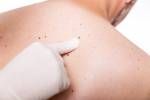 Screening der Haut eines Mannes mit Mole Lizenzfreie Bilder - 31416951