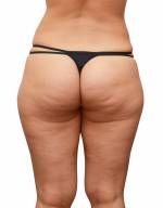 Nahaufnahme von Cellulite Haut an Gesäß Frau auf einem weißen Lizenzfreie Bilder - 10134373