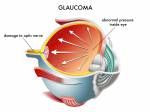 Glaukom Lizenzfreie Bilder - 14225590