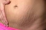 Frau Anzeige Dehnungsstreifen auf ihren Bauch nach der Schwangerschaft durch Abreißen der Dermis Schicht der Haut und zeigt als rote Verfärbungen, Nahaufnahme von ihrem Bauch verursacht Lizenzfreie Bilder - 45559337