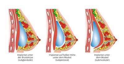 Platzierung der Brustimplantate