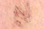 Close-up der Bein mit Krampfadern Lizenzfreie Bilder - 32497492