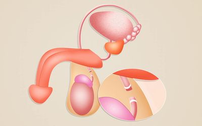 Sterilisation des Mannes (Vasektomie)