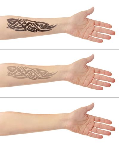 Tattooentfernung Konzept
