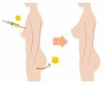 Breast fatgrant Chirurgie mit vorher nachher Bilder Lizenzfreie Bilder - 46753029