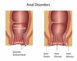 Anal Erkrankungen Lizenzfreie Bilder - 17588313