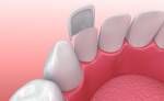Veneers: Porzellan Veneer Installation. 3D-Darstellung Lizenzfreie Bilder - 66754859