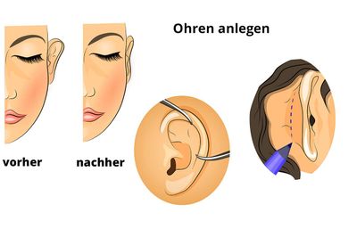 Ohren anlegen, Schema