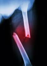 Film X-ray Left Femur (linker Oberschenkel) zeigen komplette Bruchwelle Femur und verdrängen Lizenzfreie Bilder - 32505810