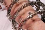 Externe Ring Fixierung Orthopädie-Technik in der Medizin Lizenzfreie Bilder - 3904827