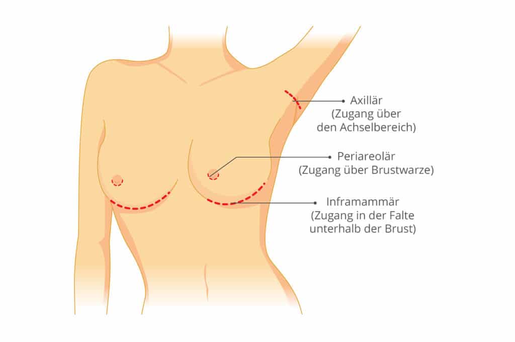 Brustauffüllung Methoden