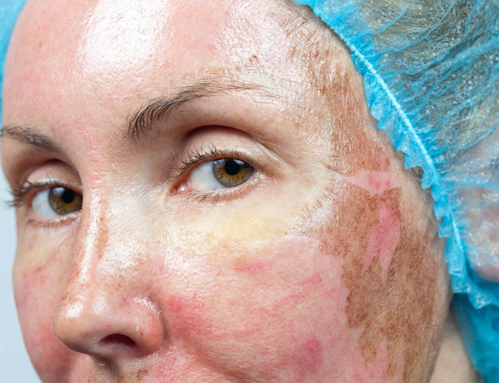 Chemisches Peeling im Gesicht