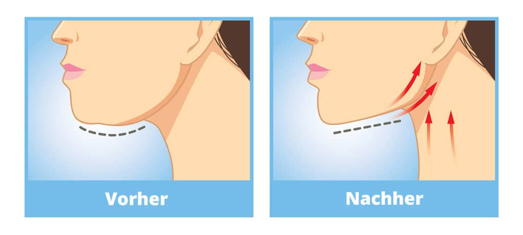 Doppelkinn Schema vorher/nachher