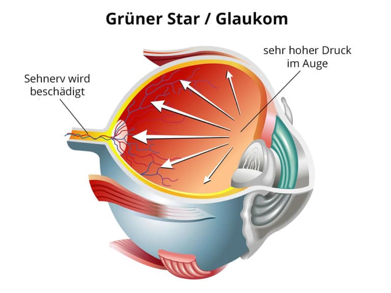 Glaukom / Schema