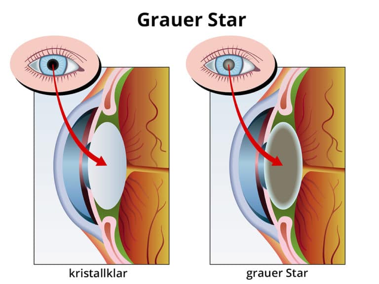 Grauer Star / Katarakt