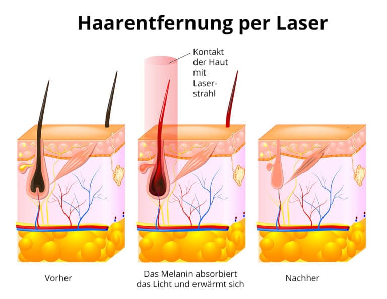 Haarentfernung per Laser
