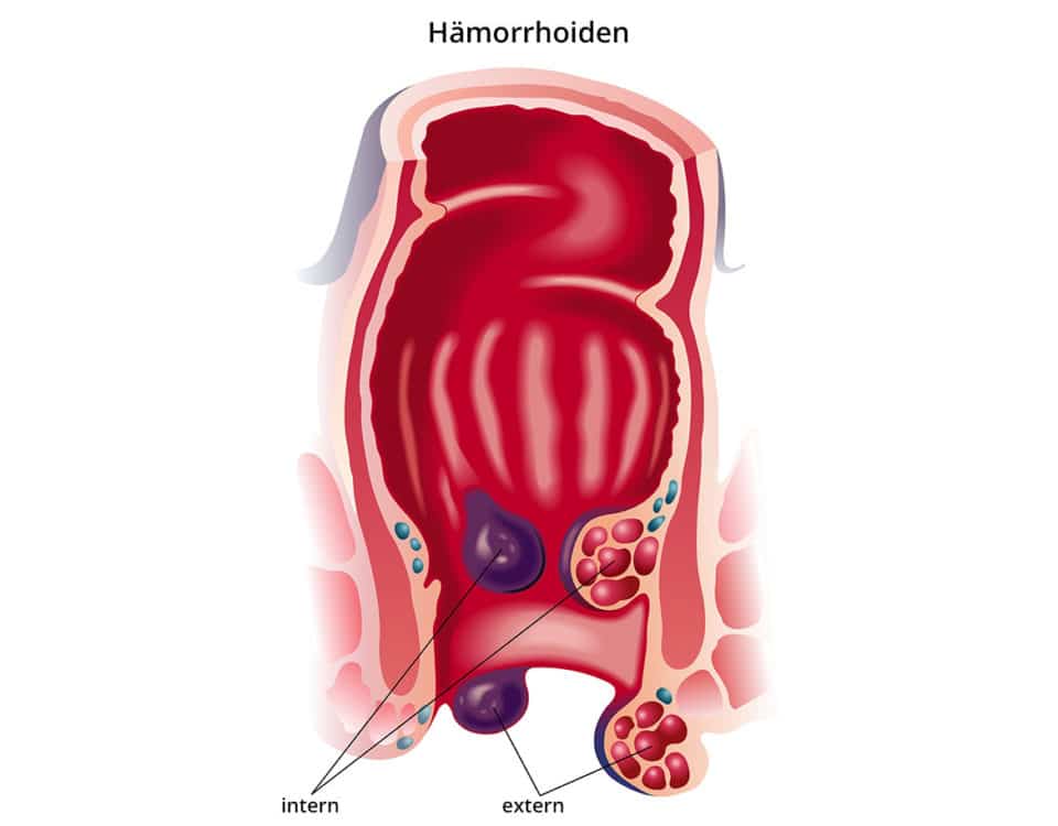 Behandlung der Hämorrhoiden - Operation.net