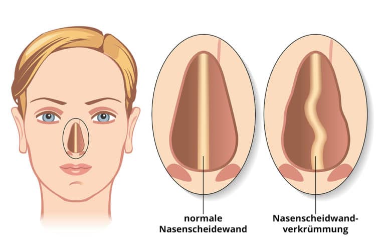 Nasenscheidewand - Schema