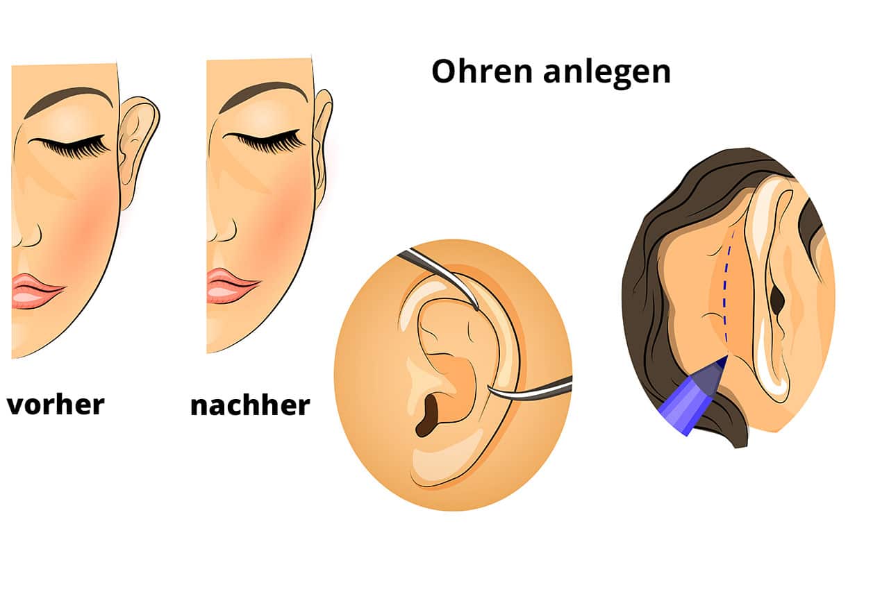 Ohren anlegen lassen: Methoden, Risiken und Kosten im Ohren anlegen lassen: Methoden, Risiken und Kosten im