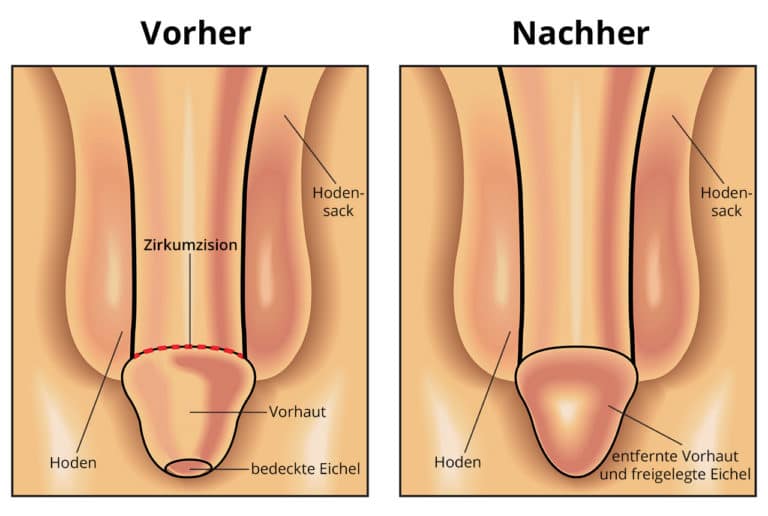 Vorhautbeschneidung / Schema