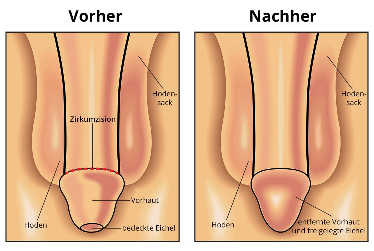 Beschneidung Vorher Nachher Bilder.